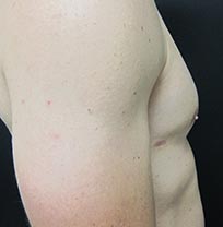 Patient abdomen after plastic surgery services by Pinehurst Plastic Surgery