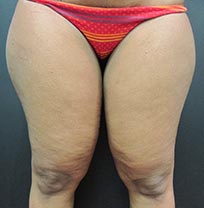 Patient legs before plastic surgery services by Pinehurst Plastic Surgery