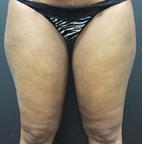 Patient legs after plastic surgery services by Pinehurst Plastic Surgery